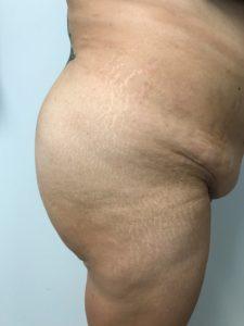 Brazilian Butt Lift after at Bao Phan MD - Hawaii Plastic Surgery Institute in Honolulu, HI