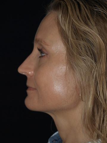 Brow Lift after at Bao Phan MD - Hawaii Plastic Surgery Institute in Honolulu, HI