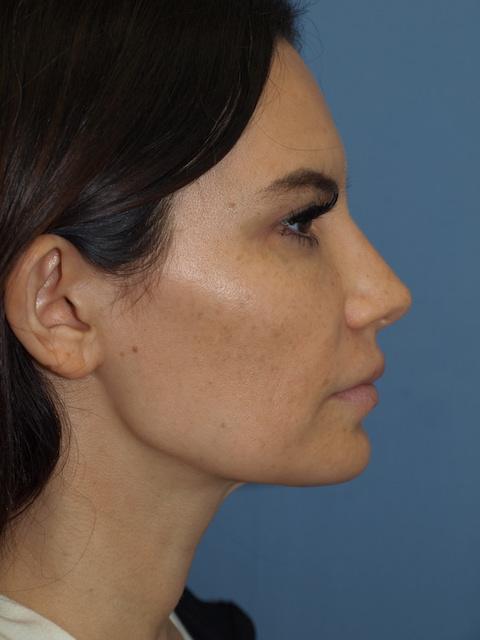 Brow Lift before at Bao Phan MD - Hawaii Plastic Surgery Institute in Honolulu, HI