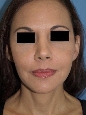 Rhinoplasty after at Bao Phan MD - Hawaii Plastic Surgery Institute in Honolulu, HI