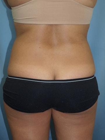 Liposuction before at Bao Phan MD - Hawaii Plastic Surgery Institute in Honolulu, HI