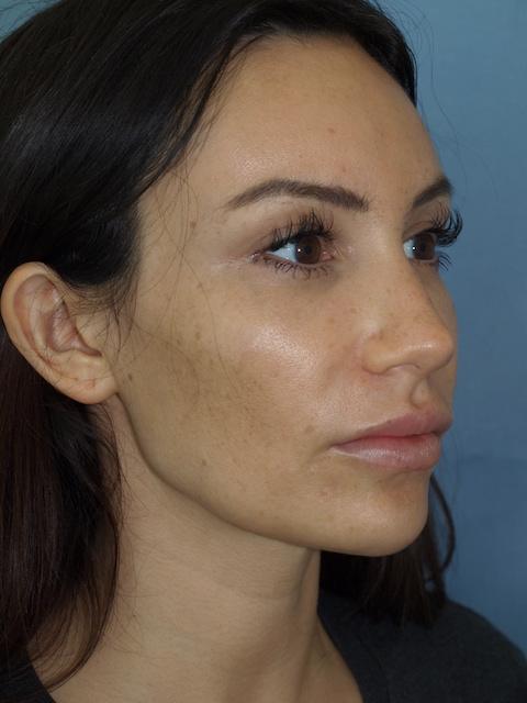 Bao Phan MD - Hawaii Plastic Surgery Institute brow lift after — Honolulu, HI