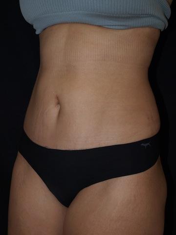 Mini Tummy Tuck after at Bao Phan MD - Hawaii Plastic Surgery Institute in Honolulu, HI
