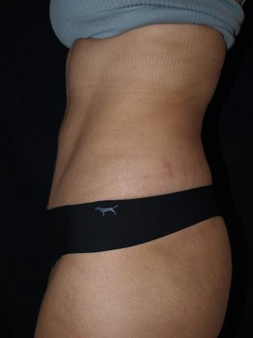 Mini Tummy Tuck after at Bao Phan MD - Hawaii Plastic Surgery Institute in Honolulu, HI
