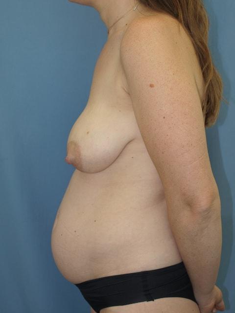 Mommy Makeover before at Bao Phan MD - Hawaii Plastic Surgery Institute in Honolulu, HI