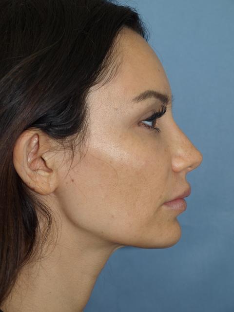 Brow Lift after at Bao Phan MD - Hawaii Plastic Surgery Institute in Honolulu, HI
