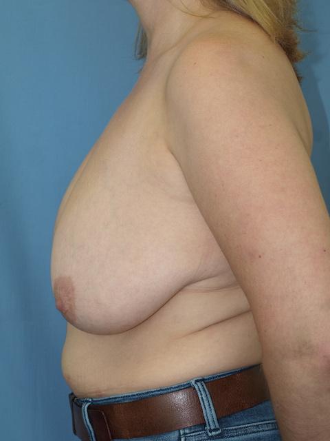 Breast Reduction before at Bao Phan MD - Hawaii Plastic Surgery Institute in Honolulu, HI