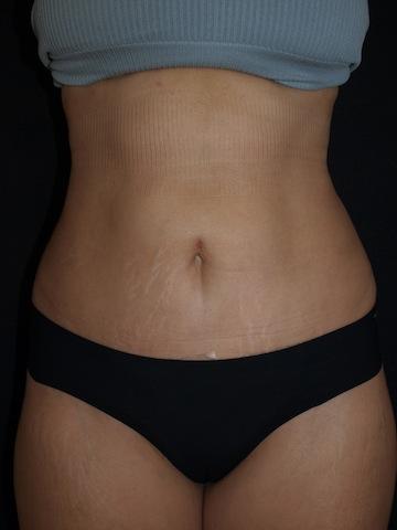 Bao Phan MD - Hawaii Plastic Surgery Institute tummy tuck after — Honolulu, HI