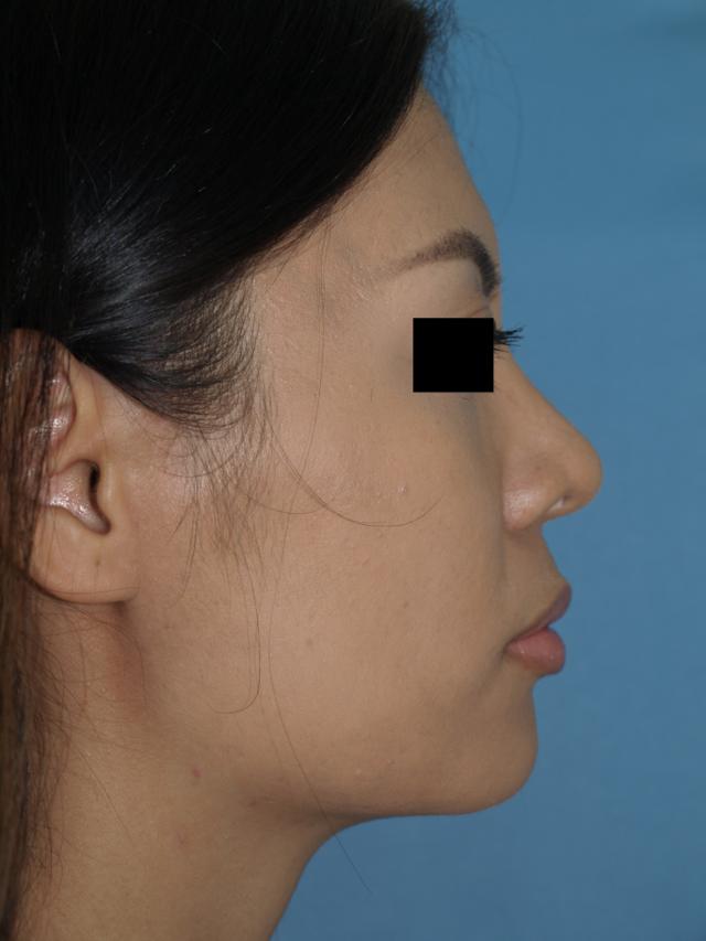 Rhinoplasty after at Bao Phan MD - Hawaii Plastic Surgery Institute in Honolulu, HI