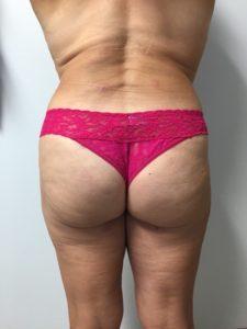 Brazilian Butt Lift after at Bao Phan MD - Hawaii Plastic Surgery Institute in Honolulu, HI