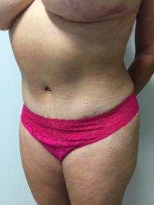 Bao Phan MD - Hawaii Plastic Surgery Institute tummy tuck after — Honolulu, HI