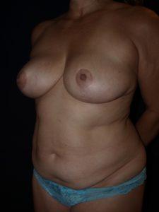 Mini Tummy Tuck before at Bao Phan MD - Hawaii Plastic Surgery Institute in Honolulu, HI