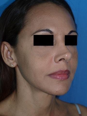 Rhinoplasty before at Bao Phan MD - Hawaii Plastic Surgery Institute in Honolulu, HI