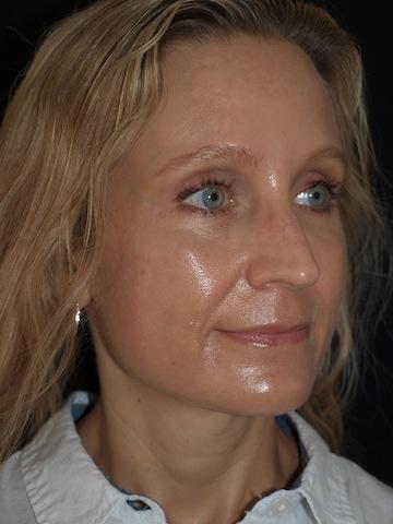 Brow Lift after at Bao Phan MD - Hawaii Plastic Surgery Institute in Honolulu, HI