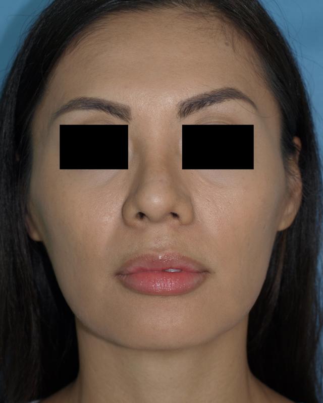Rhinoplasty after at Bao Phan MD - Hawaii Plastic Surgery Institute in Honolulu, HI