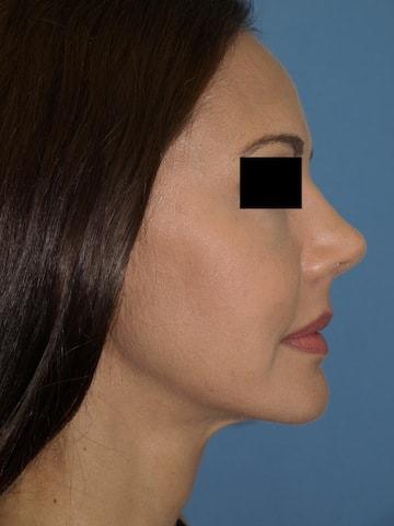 Rhinoplasty after at Bao Phan MD - Hawaii Plastic Surgery Institute in Honolulu, HI