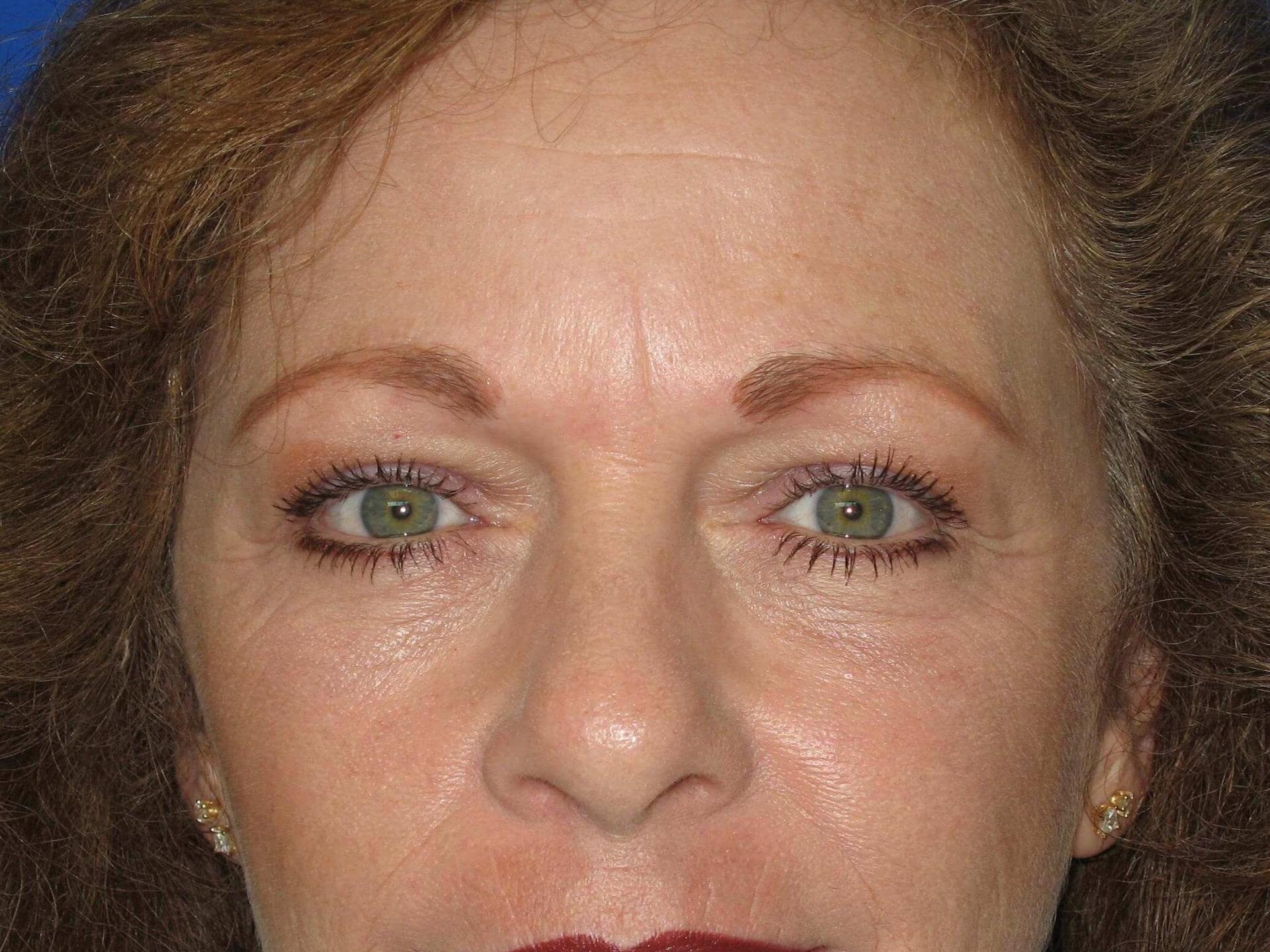 Ben Childers, MD eyelid lift after — Riverside, CA