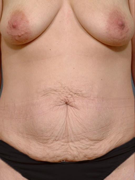 Mommy Makeover before at Bucky Plastic Surgery (Louis P. Bucky, MD) in Philadelphia, PA