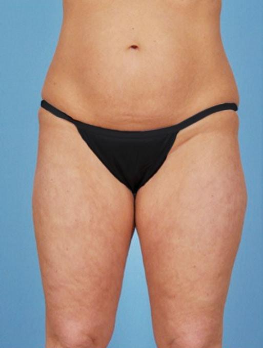Brazilian Butt Lift before at Bucky Plastic Surgery (Louis P. Bucky, MD) in Philadelphia, PA
