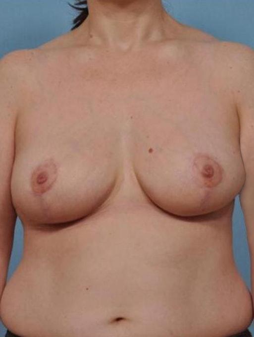 Breast Reduction after at Bucky Plastic Surgery (Louis P. Bucky, MD) in Philadelphia, PA