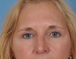 Blepharoplasty after at Bucky Plastic Surgery (Louis P. Bucky, MD) in Philadelphia, PA