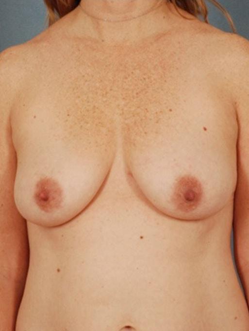 Mommy Makeover before at Bucky Plastic Surgery (Louis P. Bucky, MD) in Philadelphia, PA