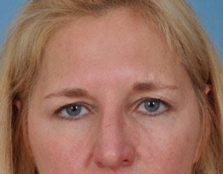 Blepharoplasty before at Bucky Plastic Surgery (Louis P. Bucky, MD) in Philadelphia, PA