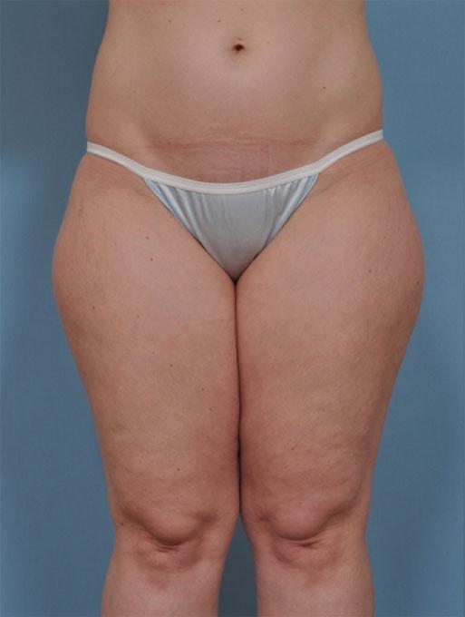Brazilian Butt Lift before at Bucky Plastic Surgery (Louis P. Bucky, MD) in Philadelphia, PA