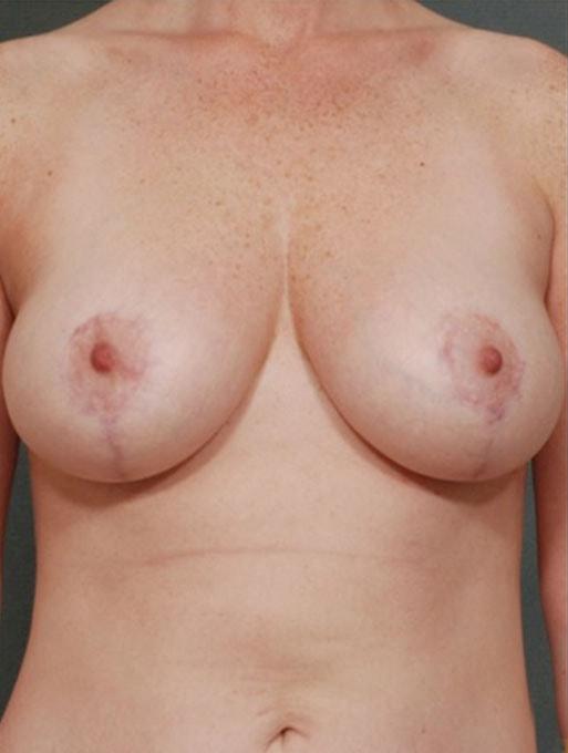 Mommy Makeover after at Bucky Plastic Surgery (Louis P. Bucky, MD) in Philadelphia, PA