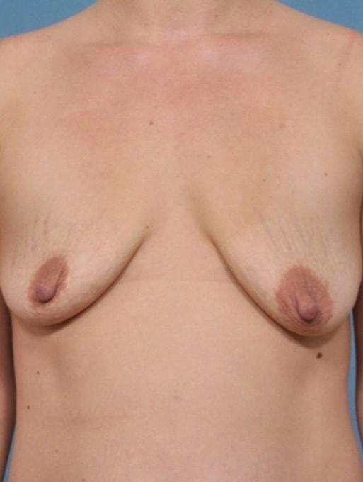 Breast Lift before at Bucky Plastic Surgery (Louis P. Bucky, MD) in Philadelphia, PA
