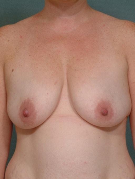 Breast Lift before at Bucky Plastic Surgery (Louis P. Bucky, MD) in Philadelphia, PA