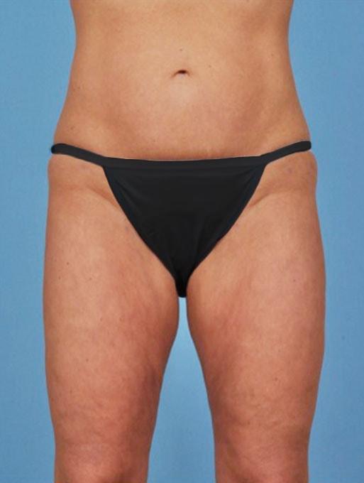 Brazilian Butt Lift after at Bucky Plastic Surgery (Louis P. Bucky, MD) in Philadelphia, PA