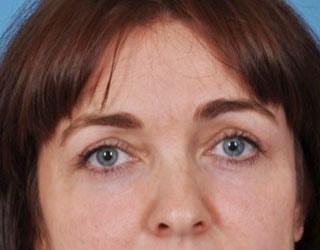 Bucky Plastic Surgery (Louis P. Bucky, MD) eyelid lift after — Philadelphia, PA
