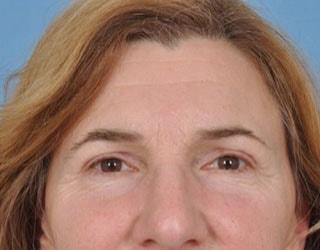 Blepharoplasty after at Bucky Plastic Surgery (Louis P. Bucky, MD) in Philadelphia, PA