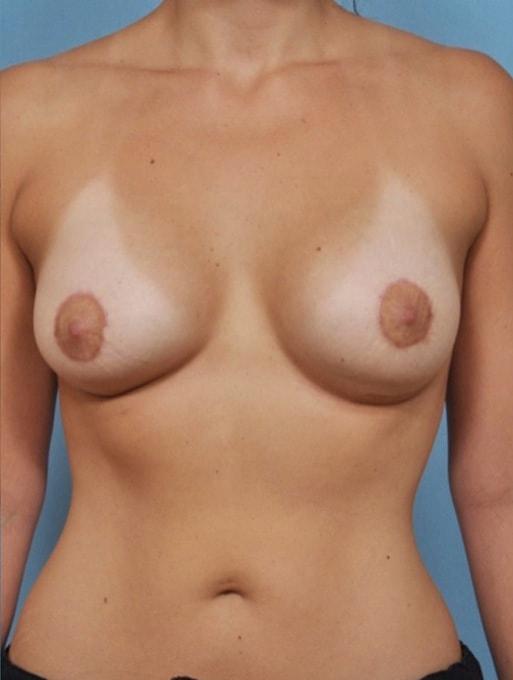 Breast Lift after at Bucky Plastic Surgery (Louis P. Bucky, MD) in Philadelphia, PA