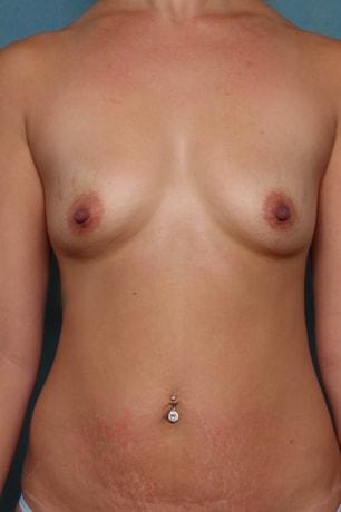Mommy Makeover before at Bucky Plastic Surgery (Louis P. Bucky, MD) in Philadelphia, PA