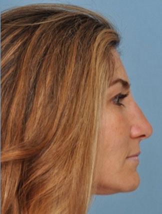 Bucky Plastic Surgery (Louis P. Bucky, MD) rhinoplasty after — Philadelphia, PA