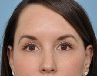Bucky Plastic Surgery (Louis P. Bucky, MD) eyelid lift after — Philadelphia, PA