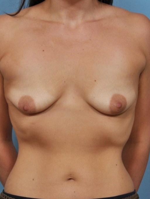 Breast Lift before at Bucky Plastic Surgery (Louis P. Bucky, MD) in Philadelphia, PA