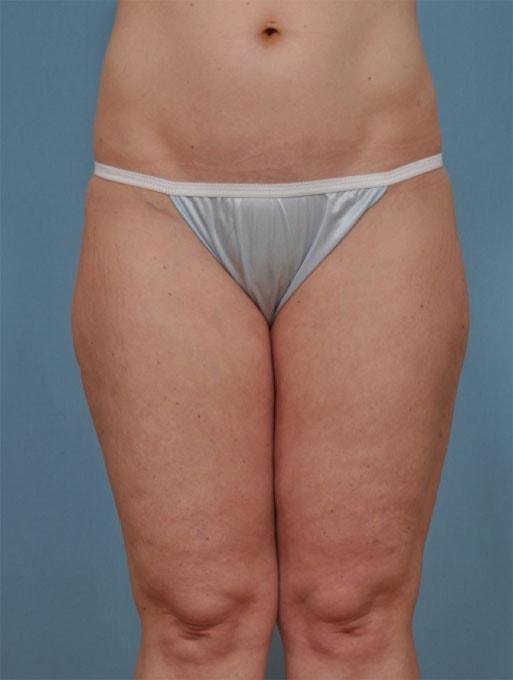 Brazilian Butt Lift after at Bucky Plastic Surgery (Louis P. Bucky, MD) in Philadelphia, PA