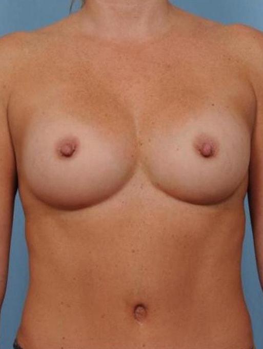 Mommy Makeover after at Bucky Plastic Surgery (Louis P. Bucky, MD) in Philadelphia, PA