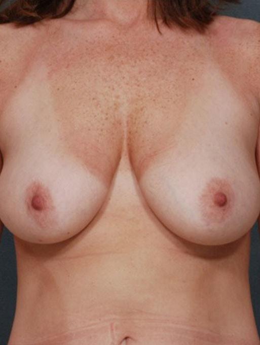 Mommy Makeover before at Bucky Plastic Surgery (Louis P. Bucky, MD) in Philadelphia, PA