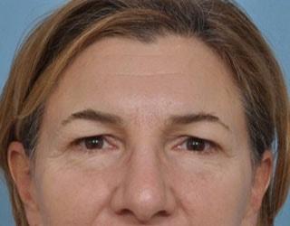 Blepharoplasty before at Bucky Plastic Surgery (Louis P. Bucky, MD) in Philadelphia, PA
