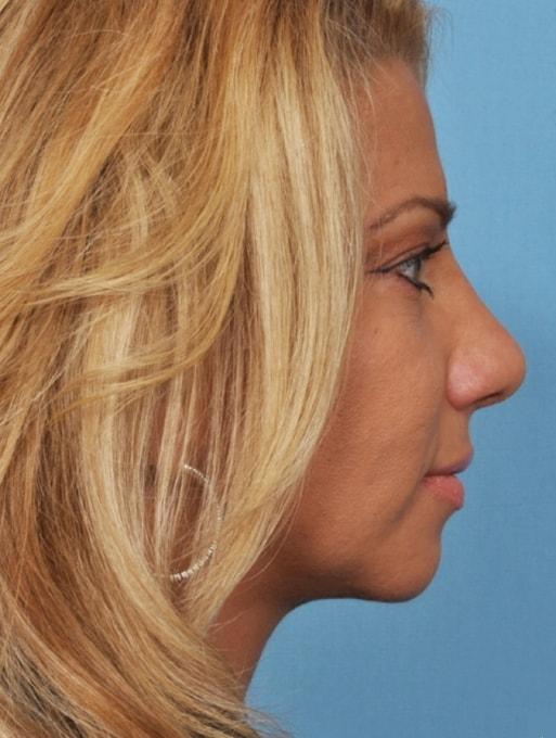 Bucky Plastic Surgery (Louis P. Bucky, MD) rhinoplasty after — Philadelphia, PA