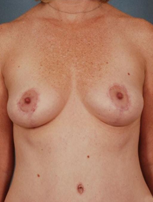 Mommy Makeover after at Bucky Plastic Surgery (Louis P. Bucky, MD) in Philadelphia, PA