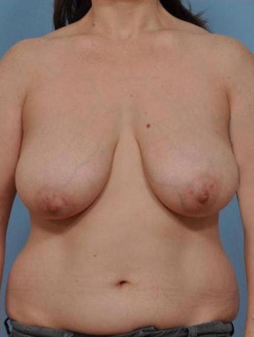 Breast Reduction before at Bucky Plastic Surgery (Louis P. Bucky, MD) in Philadelphia, PA