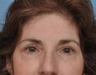 Bucky Plastic Surgery (Louis P. Bucky, MD) eyelid lift after — Philadelphia, PA