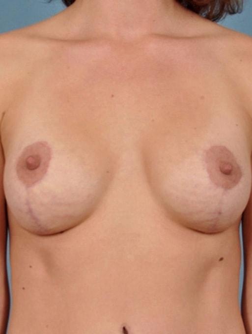 Breast Lift after at Bucky Plastic Surgery (Louis P. Bucky, MD) in Philadelphia, PA