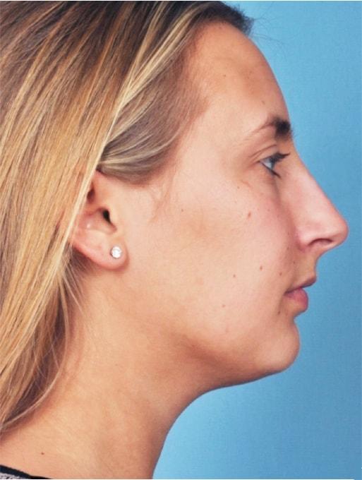 Bucky Plastic Surgery (Louis P. Bucky, MD) rhinoplasty after — Philadelphia, PA