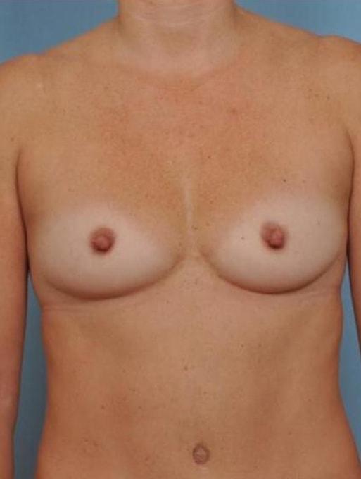 Mommy Makeover before at Bucky Plastic Surgery (Louis P. Bucky, MD) in Philadelphia, PA